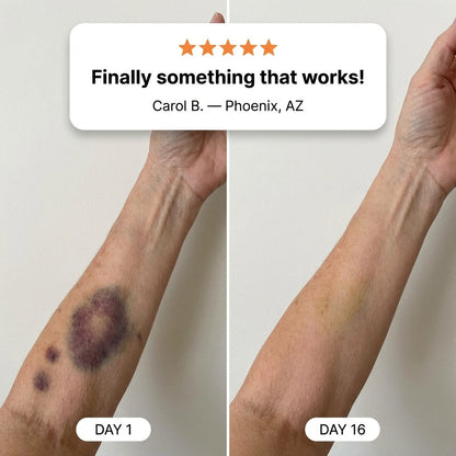 💥100K+ SOLD💡-  CureVivo® Bruise Repair & Skin Strengthening Cream
